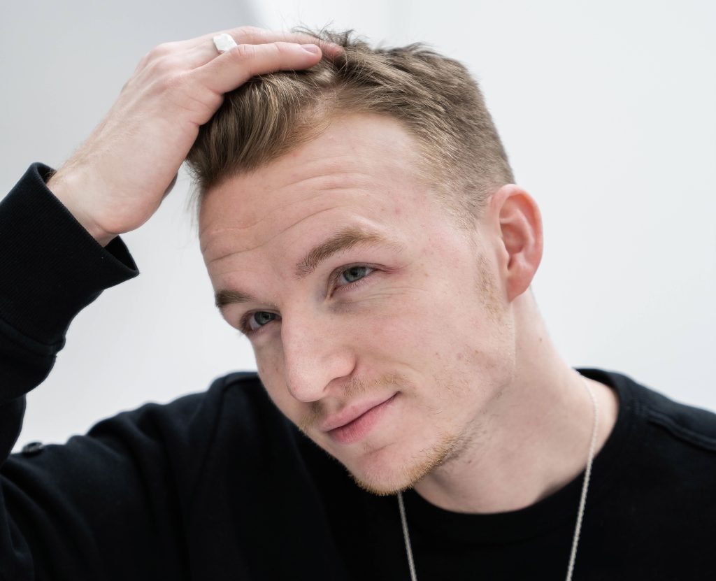 håravfall behandling, håravfall, stoppa håravfall