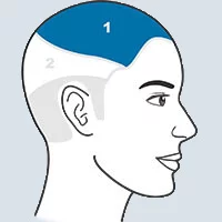 an illustration of different areas for PRP on the scalp
